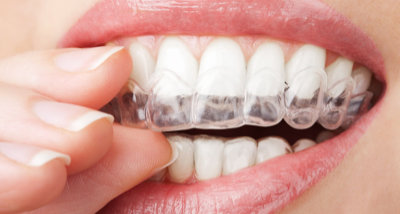 Orthodontie pour les adultes