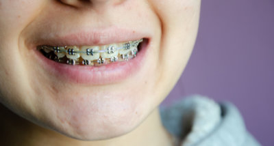 Orthodonthie pour les enfants